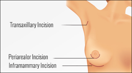 incision options periarealor incision inframammary incision