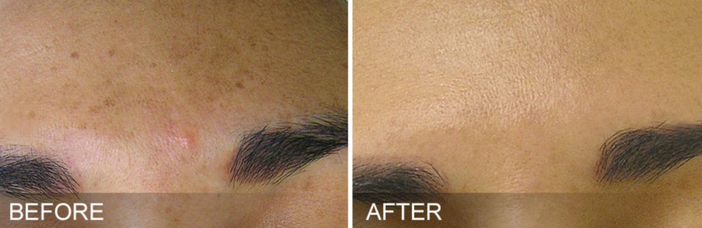 hydrafacial_before-after
