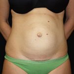 Tummy Tuck Before & After Patient #23014