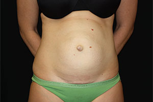 Tummy Tuck Before & After Patient #23014