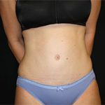 Tummy Tuck Before & After Patient #23014