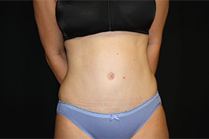 Tummy Tuck Before & After Patient #23014