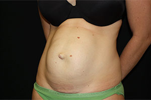 Tummy Tuck Before & After Patient #23014