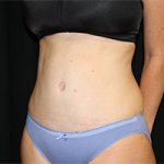 Tummy Tuck Before & After Patient #23014