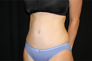 Tummy Tuck Before & After Patient #23014