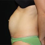 Tummy Tuck Before & After Patient #23014