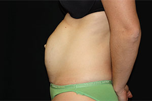 Tummy Tuck Before & After Patient #23014