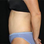 Tummy Tuck Before & After Patient #23014