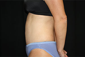 Tummy Tuck Before & After Patient #23014