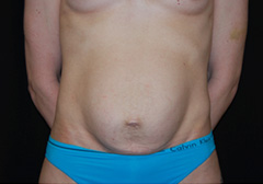 Tummy Tuck Before & After Patient #19941