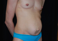 Tummy Tuck Before & After Patient #19941