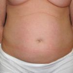 Tummy Tuck Before & After Patient #23021