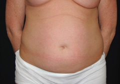 Tummy Tuck Before & After Patient #23021