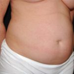 Tummy Tuck Before & After Patient #23021