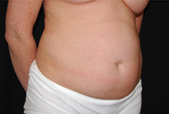 Tummy Tuck Before & After Patient #23021