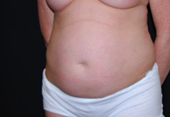 Tummy Tuck Before & After Patient #23021
