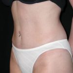 Tummy Tuck Before & After Patient #23032