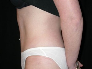 Tummy Tuck Before & After Patient #23032