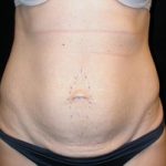 Tummy Tuck Before & After Patient #23037