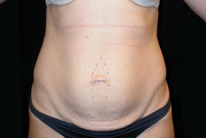 Tummy Tuck Before & After Patient #23037