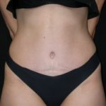 Tummy Tuck Before & After Patient #23037