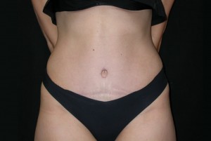 Tummy Tuck Before & After Patient #23037