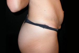 Tummy Tuck Before & After Patient #23037