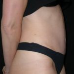 Tummy Tuck Before & After Patient #23037