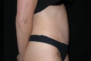 Tummy Tuck Before & After Patient #23037