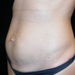 Tummy Tuck Before & After Patient #23037