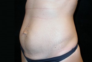 Tummy Tuck Before & After Patient #23037