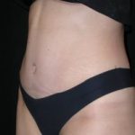 Tummy Tuck Before & After Patient #23037