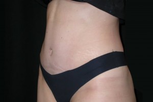 Tummy Tuck Before & After Patient #23037