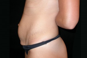 Tummy Tuck Before & After Patient #23037