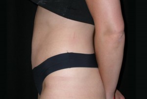 Tummy Tuck Before & After Patient #23037