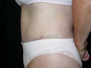 Tummy Tuck Before & After Patient #23046