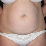 Tummy Tuck Before & After Patient #23046