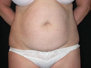 Tummy Tuck Before & After Patient #23046