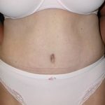 Tummy Tuck Before & After Patient #23046