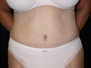 Tummy Tuck Before & After Patient #23046