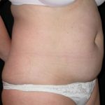 Tummy Tuck Before & After Patient #23046