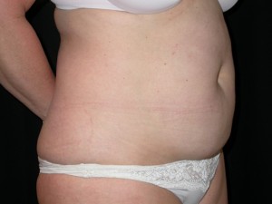 Tummy Tuck Before & After Patient #23046