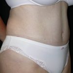 Tummy Tuck Before & After Patient #23046