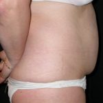 Tummy Tuck Before & After Patient #23046