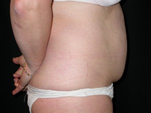 Tummy Tuck Before & After Patient #23046