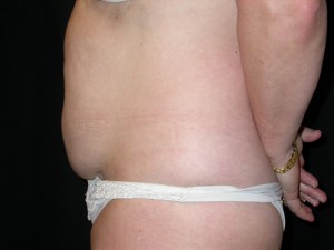 Tummy Tuck Before & After Patient #23046