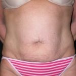 Tummy Tuck Before & After Patient #23057