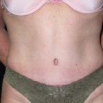 Tummy Tuck Before & After Patient #23057