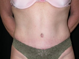 Tummy Tuck Before & After Patient #23057
