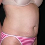 Tummy Tuck Before & After Patient #23057